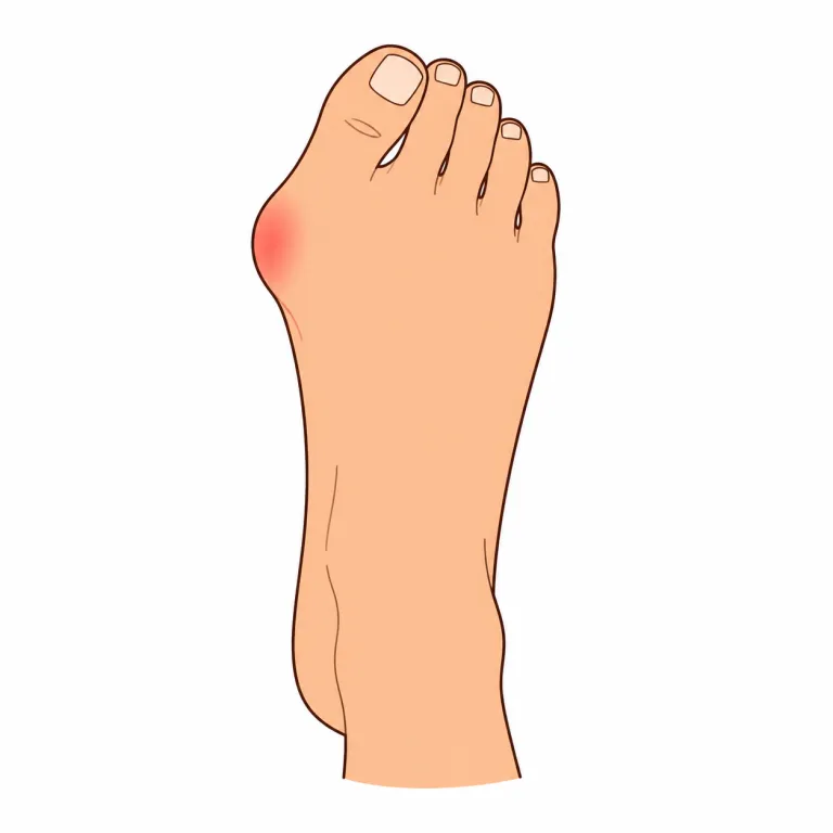 bunion（外反母趾・noun）の覚え方イラスト