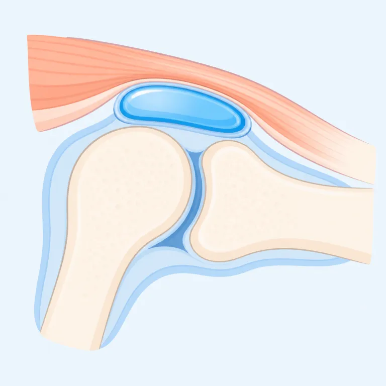 bursa（滑液包・名詞）の覚え方イラスト — まず medical English では、形より「どこで何をするか」で覚えると定着しやすい語です