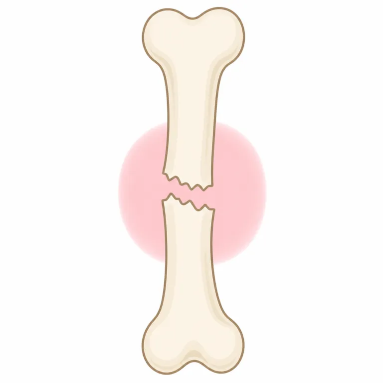 fractureの覚え方イラスト